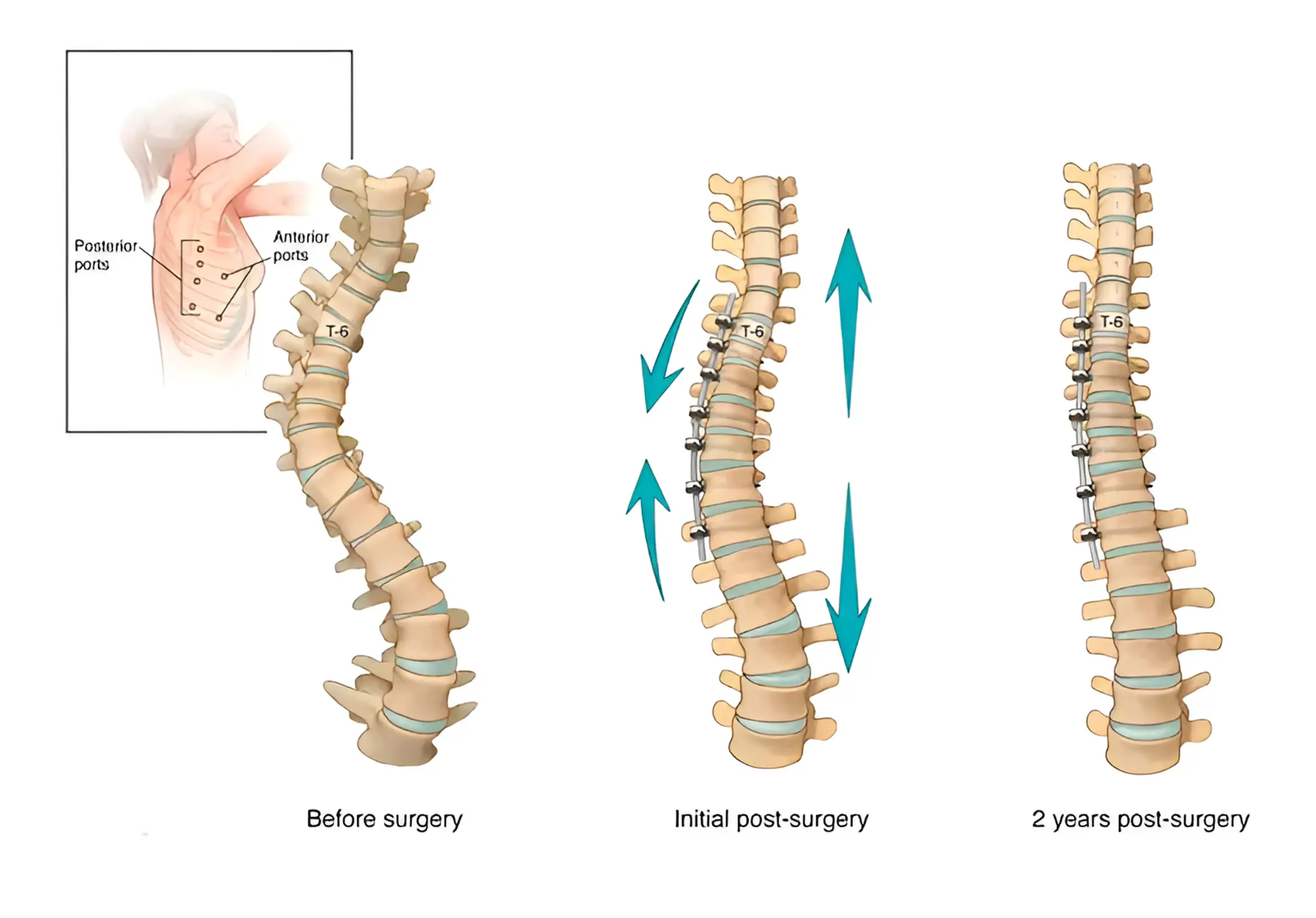 Patient standing tall after spinal correction surgery